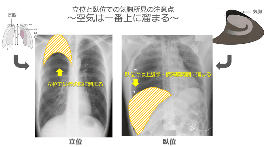 臥位の胸部レントゲンの見方② 気胸編 | ICUと呼吸器外来のあいだ