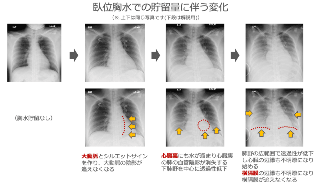 胸部レントゲン 異常 見落とし方: 肺に影があると言われた人の肺ガンの確率は – ZFWTVD